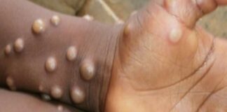 Singapura Catat 11 Kasus Cacar Monyet, Batam Tingkatkan Pengawasan di Pintu Masuk