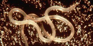 Ngeri, Cacing Hidup Berkeliaran di Otak Seorang Wanita