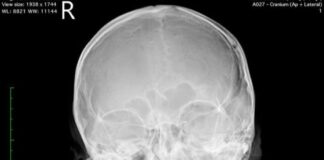 Korban Penganiayaan di Apartemen Formosa Alami Retak di Tengkorak Kepala penganiayaan di apartemen formosa